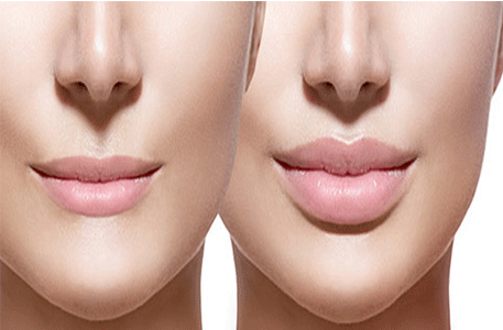 lip-lift-Botox