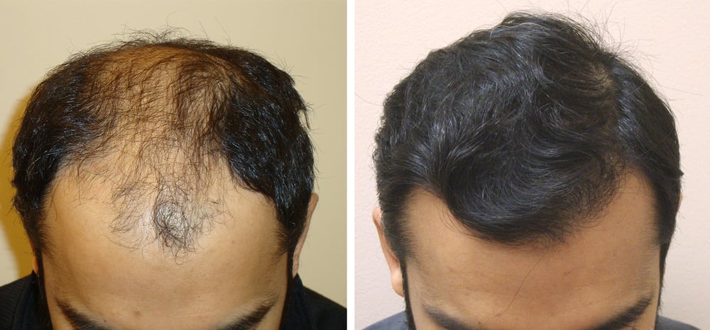 laser hair removal | acne scar treatment | laser hair removal permanent: Hair  Transplantation
