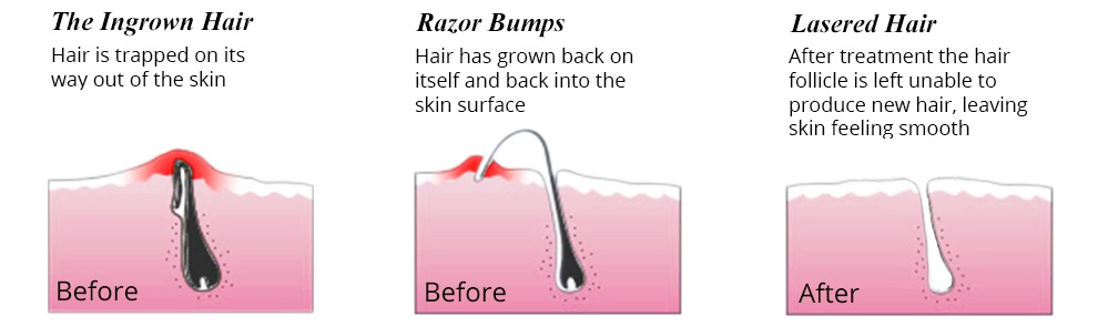 laser hair removal | acne scar treatment | laser hair removal permanent:  It's Time to Get Rid of Ingrown Hair Permanently