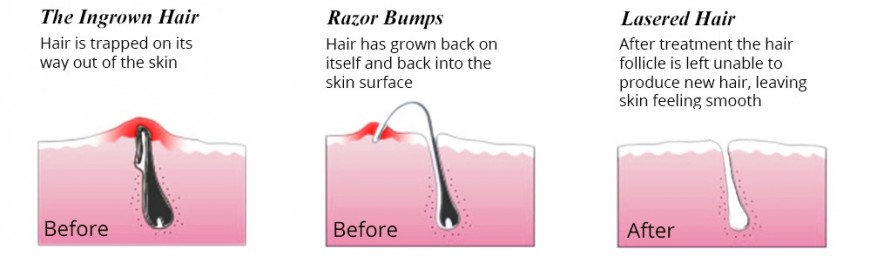 laser hair removal | acne scar treatment | laser hair removal permanent:  It's Time to Get Rid of Ingrown Hair Permanently